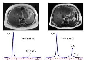 NAFLD